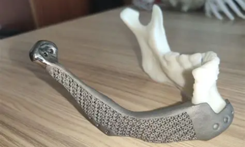 Titanium mandibular implant